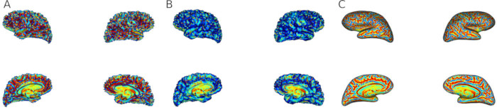 Figure 4: Different visualization surfaces. A white surface. B pial surface. C inflated surface.